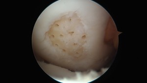 Articular Cartilage Injury after Debridement and Microfracture