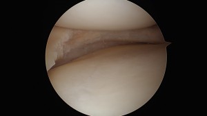 Trimmed Medial Meniscal Cartilage