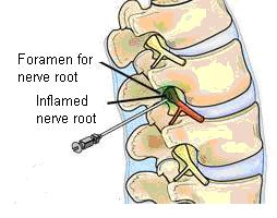 Nerve Root Injection