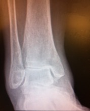 Ankle joint arthritis