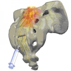 Caudal Epidural