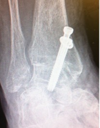 A fused ankle joint