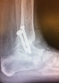 A fused ankle joint