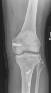 X Ray after surgery to reconstruct the medial patella femoral ligaments and move the tibial tubercle distally