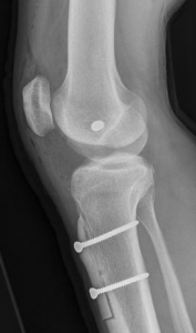 X Ray after surgery to reconstruct the medial patella femoral ligaments and move the tibial tubercle distally