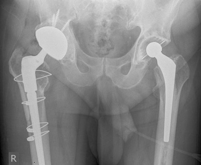 Revision Hip Replacement