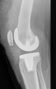 standard total knee replacement